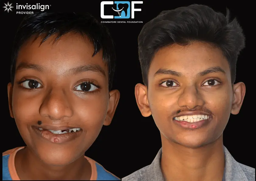 Braces Before After
